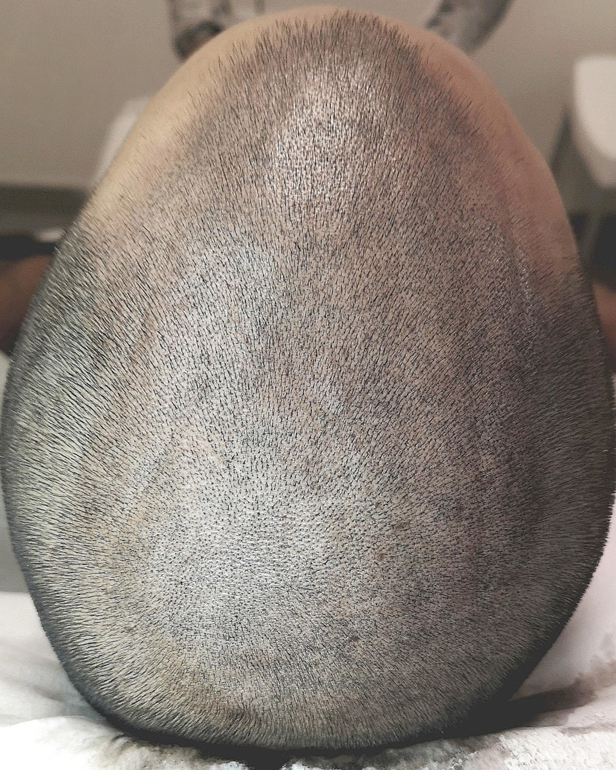 Scalp